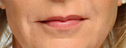 Lippenfältchen nachher