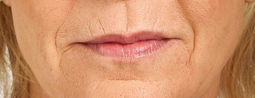 Lippenfältchen vorher